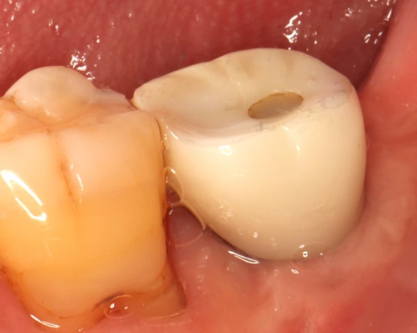 Clinical photograph of the implant crown and surrounding gums at five-year follow-up after peri-implantitis treatment.
